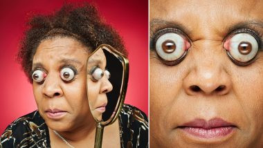 Mulher com o olho mais saltado do mundo - Imagem: Internet